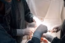 Ăn quả hồng liên tục, bé gái 14 tuổi bị tắc ruột