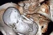 Thai nhi nằm trong bụng suốt 35 năm mà mẹ không hay biết