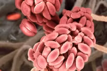 Người đầu tiên trên thế giới nhiễm nấm từ cây trồng 