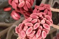 Người đầu tiên trên thế giới nhiễm nấm từ cây trồng 