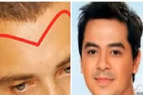 Nhìn trán biết số mệnh: 5 tướng trán sướng từ trong trứng, ngồi mát ăn bát vàng