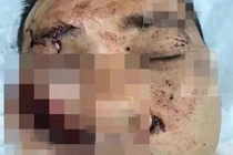 Diễn viên Hoàng Tuấn Phong bị chém 3 nhát vào mặt, bất tỉnh tại chỗ 