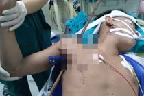 Cứu nam công nhân bị thanh sắt đâm xuyên nách