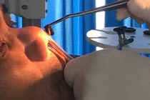 Hết hồn những trường hợp đỉa chui vào mũi, họng do bất cẩn