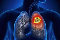 Lý do không hút thuốc vẫn mắc ung thư phổi