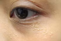 Không cần dùng tia laser mụn thịt cũng bay hết với lá này