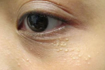 Không cần dùng tia laser mụn thịt cũng bay hết với lá này