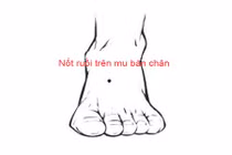 Nốt ruồi trên bàn chân nói lên điều gì? 