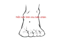Nốt ruồi trên bàn chân nói lên điều gì? 