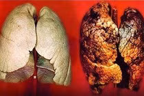 Phát hiện sớm ung thư phổi nhờ xét nghiệm máu