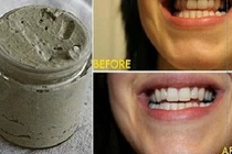 Học cách tự chế kem đánh răng chữa sâu răng hiệu quả