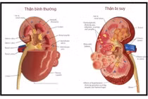 Những dấu hiệu cảnh báo thận sắp hỏng mà không biết