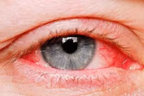 Làm gì khi đi chơi Tết bất ngờ bị đau mắt đỏ? 