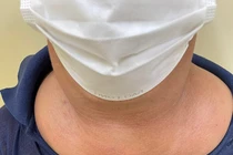 U do rối loạn chuyển hóa mỡ và uống rượu