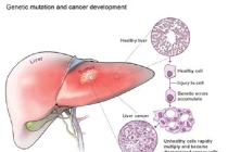 Những biểu hiện của bệnh ung thư gan 