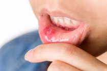 Nguyên nhân và cách chữa nhiệt miệng hiệu quả tại nhà