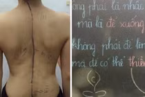 Tập yoga sai cách, cô gái đau đớn vì bệnh cột sống ngày càng nặng