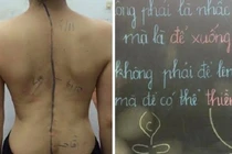 Tập yoga sai cách, cô gái đau đớn vì bệnh cột sống ngày càng nặng