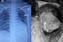 Cứu sống người phụ nữ bị đâm thấu tim, mất hơn 3 lít máu