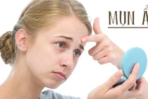 Sử dụng công thức này tiêu diệt mụn ẩn tận gốc