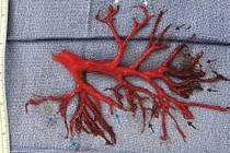 Hy hữu người đàn ông ho ra cả 'cây phế quản' rồi qua đời