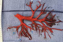 Hy hữu người đàn ông ho ra cả 'cây phế quản' rồi qua đời