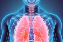 Mắc bệnh viên phổi "dễ như chơi" bởi lý do thường gặp