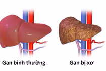 Chuyên gia chỉ điểm 5 kiểu người dễ ung thư gan, bạn có trong số đó?