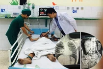 Bé trai vỡ đại tràng, nguy kịch vì bạn bơm hơi vào hậu môn