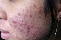 Mặt nữ sinh chi chít mụn vì dùng mỹ phẩm "thần thánh" làm đẹp đón Tết