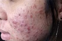 Mặt nữ sinh chi chít mụn vì dùng mỹ phẩm "thần thánh" làm đẹp đón Tết