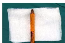 Bị bạn trêu đùa, bé trai ngồi vào bút chì đâm thấu mông, sâu 8cm