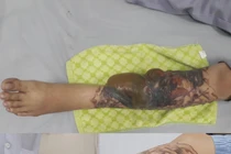 Hoại tử chân vì xóa hình xăm bằng laser