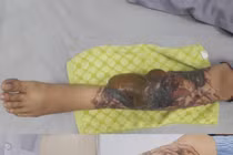 Hoại tử chân vì xóa hình xăm bằng laser