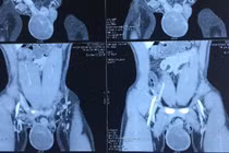 Phát hiện ung thư tinh hoàn nhờ dấu hiệu không ngờ này