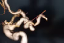 Đau đầu dữ dội, buồn nôn - biểu hiện của bệnh lạ dễ dẫn đến tử vong