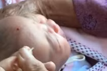 Dùng kim chích đẹn đến chảy máu đầu, giúp con hay hại con?