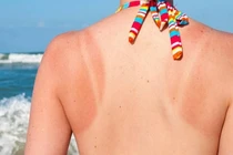 8 cách chữa cháy nắng cho da cực đơn giản mà hiệu quả