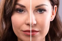 Bài tập yoga giảm béo mặt, xóa mờ nếp nhăn thần kì