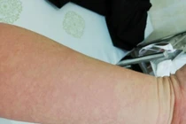 Nhập viện cấp cứu khi phun môi tại Thẩm mỹ viện Ngọc Dung