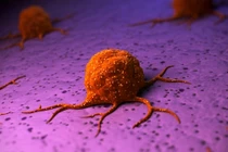 Người đàn ông mắc 3 loại ung thư cùng lúc, bác sĩ chỉ mặt thủ phạm