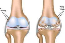 Cảnh báo bệnh thoái hóa khớp ở người trẻ, cách nào để phòng ngừa?
