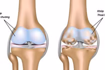 Cảnh báo bệnh thoái hóa khớp ở người trẻ, cách nào để phòng ngừa?