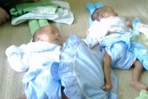 Cặp song sinh suy dinh dưỡng nặng, mẹ bỏ đi, bố không có tiền mua sữa