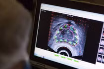 Ung thư tiền liệt tuyến có mấy loại?