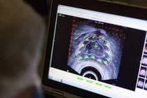 Ung thư tiền liệt tuyến có mấy loại?