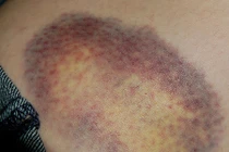 Mẹo làm mờ vết thâm tím cực nhanh 