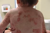 Xót lòng bé gái bị lột da toàn thân chỉ trong 1 tuần