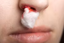 Cách xử trí chảy máu cam đúng mà nhiều người không biết