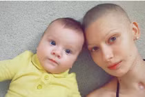 Ảnh tuyệt đẹp người mẫu bị mất hàm vì ung thư xương